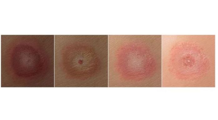 Sarpullido de la Enfermedad de Lyme